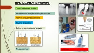 NON INVASIVE METHODS:
The surgeon’s perception
Radiographical analysis/imaging techniques
Insertion torque measurements
Reverse torque test
Cutting torque resistance Analysis
Percussion test
 