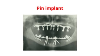 Pin implant
 
