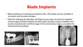 Blade Implants
• Blade implants are endosseous implants with a flat shape and are available in
one-piece and two-piece designs.
• With the widespread utilization and high success rates of root form implants,
overall usage of blade implants has decreased, but they remain available from
several manufacturers and find usage in the narrow bony ridge as an option for
horizontal bone grafting.
 
