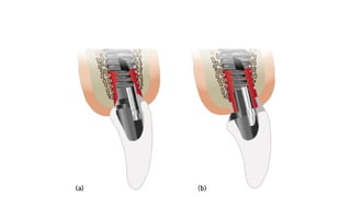 good Osseointegration during implant.ppt