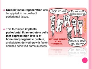  Guided tissue regeneration can
be applied to reconstruct
periodontal tissue.
 This technique implants
periodontal ligament stem cells
that express high levels of
bone morphogenetic protein,
and platelet-derived growth factor
and has achieved some success
 