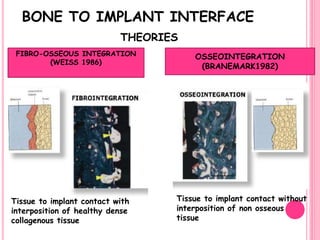 BONE TO IMPLANT INTERFACE
THEORIES
FIBRO-OSSEOUS INTEGRATION
(WEISS 1986)
OSSEOINTEGRATION
(BRANEMARK1982)
Tissue to implant contact with
interposition of healthy dense
collagenous tissue
Tissue to implant contact without
interposition of non osseous
tissue
 