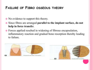 FAILURE OF FIBRO OSSEOUS THEORY
 No evidence to support this theory.
 Since fibres are arranged parallel to the implant surface, do not
help in force transfer.
 Forces applied resulted in widening of fibrous encapsulation,
inflammatory reaction and gradual bone resorption thereby leading
to failure.
 
