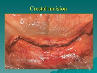 OSSEOINTEGRATION AND IMPLANT PLACEMENT.ppt