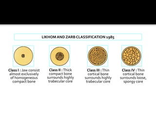 LIKHOM AND ZARB CLASSIFICATION 1985
Class I : Jaw consist
almost exclusively
of homogeneous
compact bone
Class II :Thick
compact bone
surrounds highly
trabecular core
Class III :Thin
cortical bone
surrounds highly
trabecular core
Class IV :Thin
cortical bone
surrounds loose,
spongy core
 
