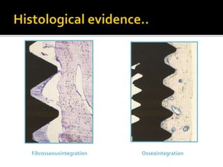 Fibrosseousintegration Osseointegration
 