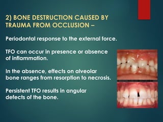 Periodontal Bone Loss and Patterns of Bone Destruction | PPTX
