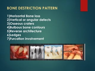 Periodontal Bone Loss and Patterns of Bone Destruction | PPTX