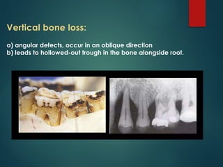 Periodontal Bone Loss and Patterns of Bone Destruction | PPTX