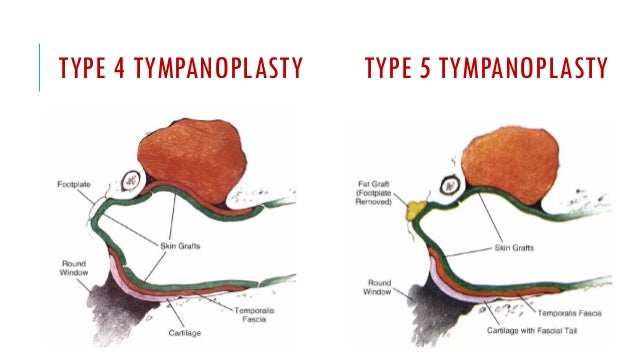 Ossicular reconstruction