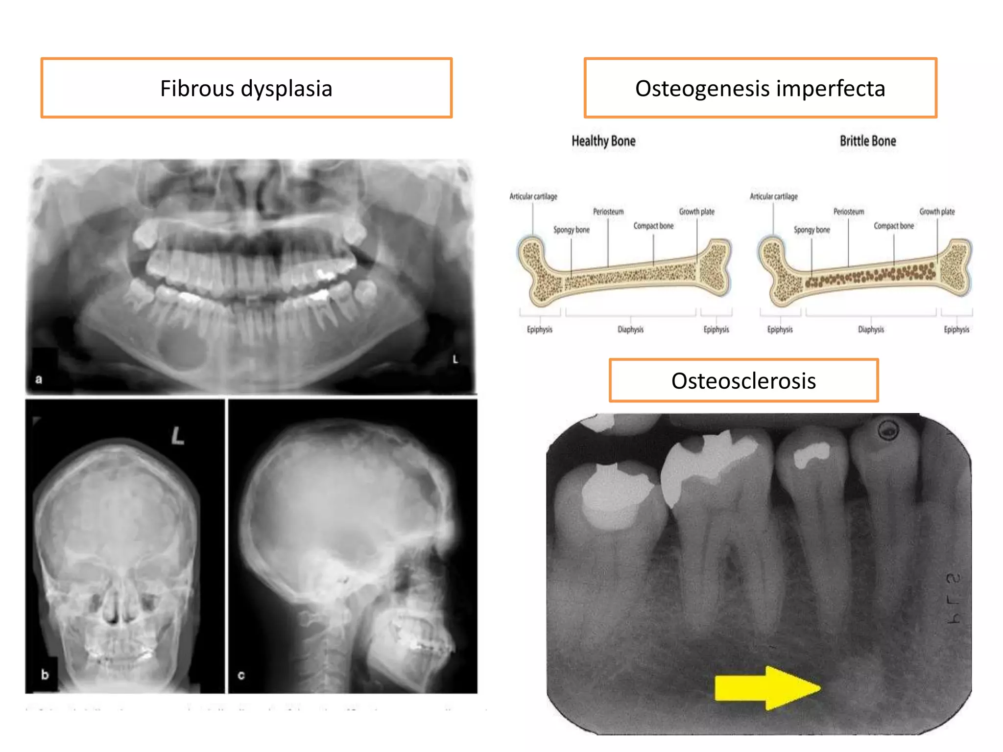 Osteogenesis imperfectaFibrous dysplasia
Osteosclerosis
 