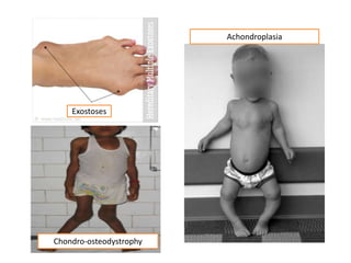 Chondro-osteodystrophy
Exostoses
Achondroplasia
 