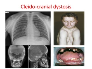 Cleido-cranial dystosis
 