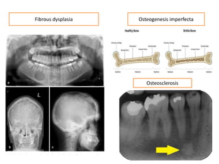 Osteogenesis imperfectaFibrous dysplasia
Osteosclerosis
 