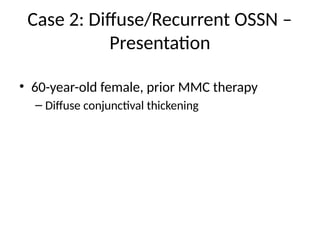 Case 2: Diffuse/Recurrent OSSN –
Presentation
• 60-year-old female, prior MMC therapy
– Diffuse conjunctival thickening
 