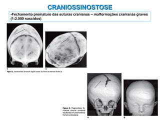 CRANIOSSINOSTOSE
-Fechamento prematuro das suturas cranianas – malformações cranianas graves
(1:2.000 nascidos)
 