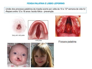 -União dos processo palatinos da maxila ocorre por volta da 10 e 12ª semana de vida IU
-Reparo entre 12 e 18 anos //acido fólico - prevenção
FENDA PALATINA E LÁBIO LEPORINO
 