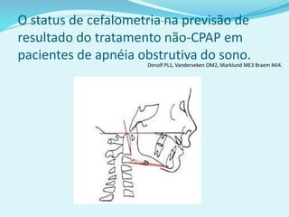 O status de cefalometria na previsão de
resultado do tratamento não-CPAP em
pacientes de apnéia obstrutiva do sono.
Denolf PL1, Vanderveken OM2, Marklund ME3 Braem MJ4.
 