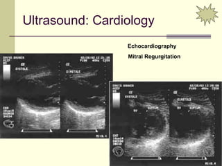 86
Ultrasound: Cardiology
Echocardiography
Mitral Regurgitation
 