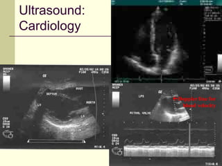 87
Ultrasound:
Cardiology
Doppler line for
blood velocity
 