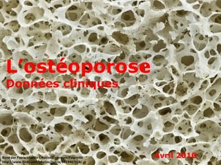 L’ostéoporose Données cliniques Avril 2010 Bone par Patrix Licence Creative Commons Paternité http://www.flickr.com/photos/patrix/2719467658/ 