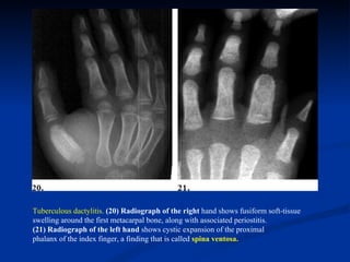 Osteo articular tuberculosis -1 | PPT