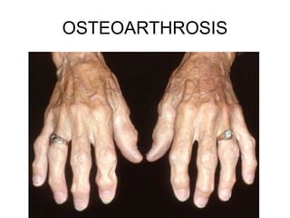 OSTEOARTHROSIS
 