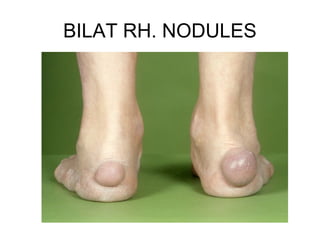 BILAT RH. NODULES
 