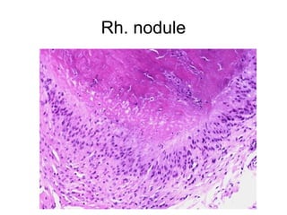 Rh. nodule
 