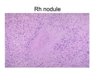 Rh nodule
 
