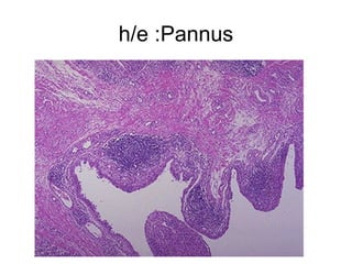 h/e :Pannus
 