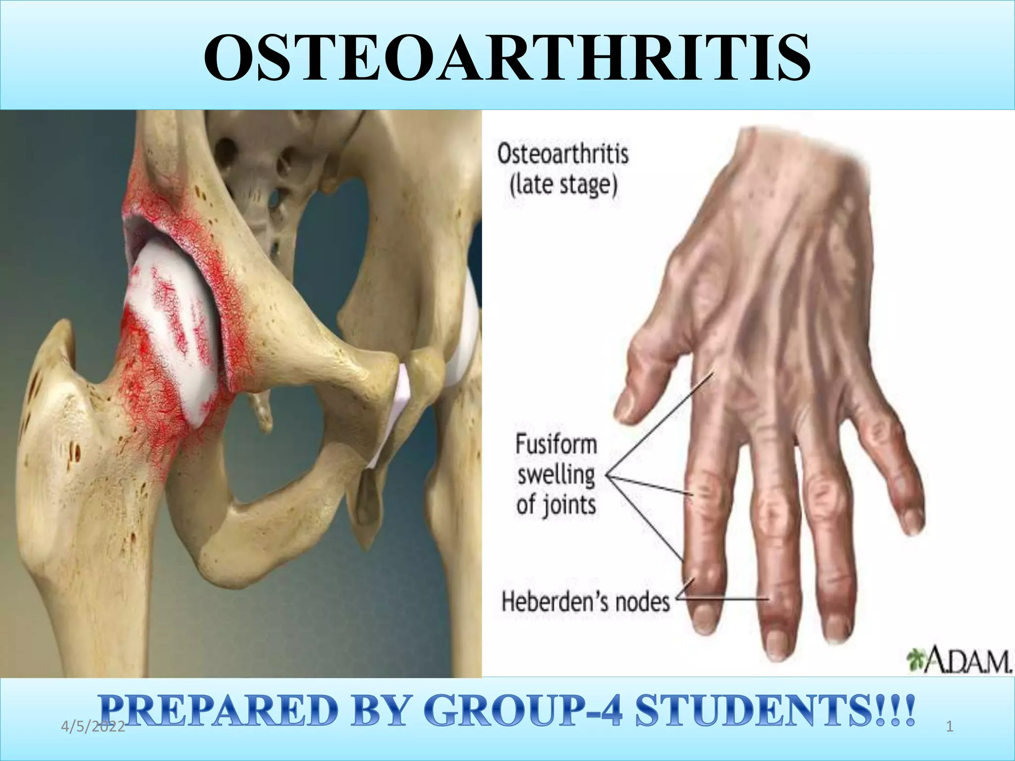 Osteoarthritis treatment | PPTX