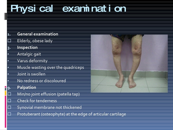 osteoarthritis