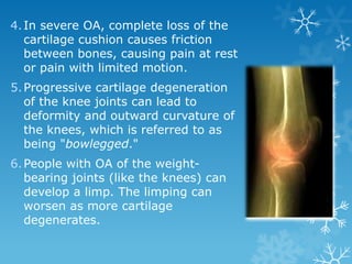 4. In severe OA, complete loss of the
   cartilage cushion causes friction
   between bones, causing pain at rest
   or pain with limited motion.
5. Progressive cartilage degeneration
   of the knee joints can lead to
   deformity and outward curvature of
   the knees, which is referred to as
   being "bowlegged."
6. People with OA of the weight-
   bearing joints (like the knees) can
   develop a limp. The limping can
   worsen as more cartilage
   degenerates.
 