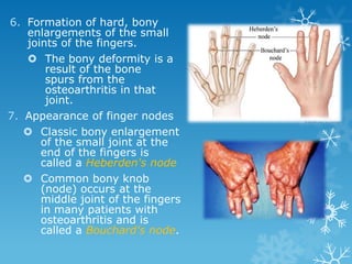 6. Formation of hard, bony
   enlargements of the small
   joints of the fingers.
    The bony deformity is a
       result of the bone
       spurs from the
       osteoarthritis in that
       joint.
7. Appearance of finger nodes
    Classic bony enlargement
      of the small joint at the
      end of the fingers is
      called a Heberden's node
    Common bony knob
      (node) occurs at the
      middle joint of the fingers
      in many patients with
      osteoarthritis and is
      called a Bouchard's node.
 