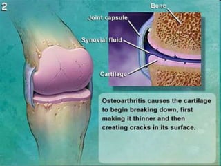 Osteoarthritis | PPTX