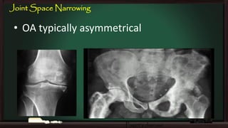 Joint Space Narrowing

• OA typically asymmetrical

Paget’s disease

 
