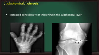 Subchondral Sclerosis
• Increased bone density or thickening in the subchondral layer

 