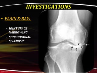 INVESTIGATIONS
• PLAIN X-RAY:
– JOINT SPACE
NARROWING
– SUBCHONDRAL
SCLEROSIS
 