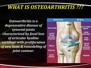 WHAT IS OSTEOARTHRITIS ???
Osteoarthritis is a
degenerative disease of
synovial joints
characterized by focal loss
of articular hyaline
cartilage with proliferation
of new bone & remodeling of
joint contour.
 