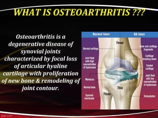 EPIDEMIOLOGY
• Weight bearing joints e.g. knee & hip joints.
• Age > 65 years.
– 80% have radiographic features.
– 25-30% ...