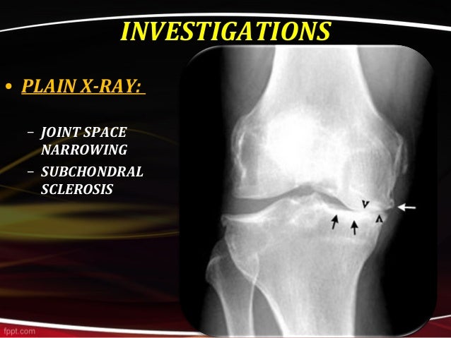 subchondral sclerosis