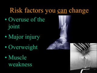 • Overuse of the
joint
• Major injury
• Overweight
• Muscle
weakness
Risk factors you can change
 