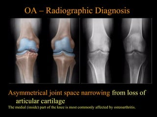 Asymmetrical joint space narrowing from loss of
articular cartilage
The medial (inside) part of the knee is most commonly affected by osteoarthritis.
OA – Radiographic Diagnosis
 