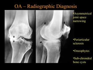 OA – Radiographic Diagnosis
•Asymmetrical
joint space
narrowing
•Periarticular
sclerosis
•Osteophytes
•Sub-chrondral
bone cysts
 