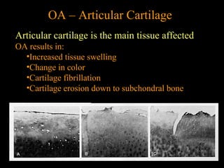 OA – Articular Cartilage
Articular cartilage is the main tissue affected
OA results in:
•Increased tissue swelling
•Change in color
•Cartilage fibrillation
•Cartilage erosion down to subchondral bone
 