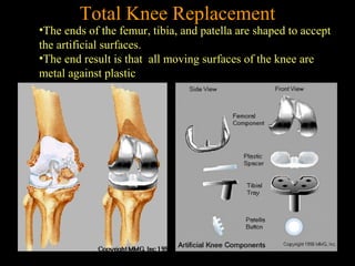 •The ends of the femur, tibia, and patella are shaped to accept
the artificial surfaces.
•The end result is that all moving surfaces of the knee are
metal against plastic
Total Knee Replacement
 