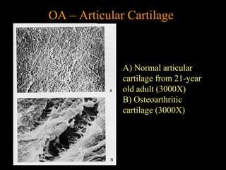 OA – Articular Cartilage
A) Normal articular
cartilage from 21-year
old adult (3000X)
B) Osteoarthritic
cartilage (3000X)
 