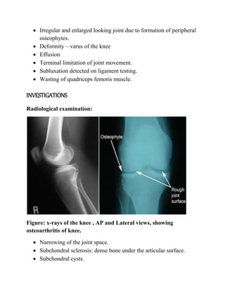  Irregular and enlarged looking joint due to formation of peripheral
osteophytes.
 Deformity – varus of the knee
 Effusion
 Terminal limitation of joint movement.
 Subluxation detected on ligament testing.
 Wasting of quadriceps femoris muscle.
INVESTIGATIONS
Radiological examination:
Figure: x-rays of the knee , AP and Lateral views, showing
osteoarthritis of knee.
 Narrowing of the joint space.
 Subchondral sclerosis: dense bone under the articular surface.
 Subchondral cysts.
 