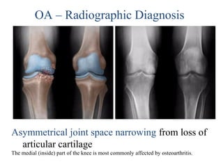 Asymmetrical joint space narrowing from loss of
articular cartilage
The medial (inside) part of the knee is most commonly affected by osteoarthritis.
OA – Radiographic Diagnosis
 